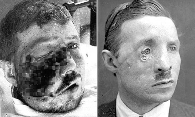 Солдаты Первой мировой - пациенты первых пластических хирургов