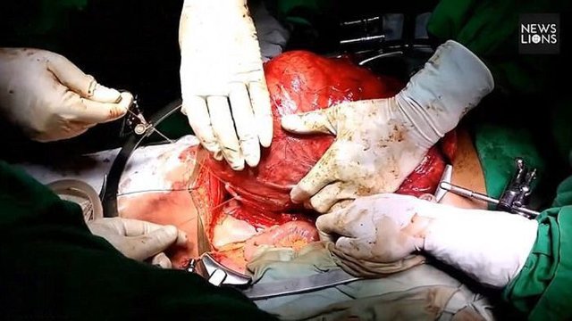 Хирурги удалили самую большую в мире опухоль из почки женщины
