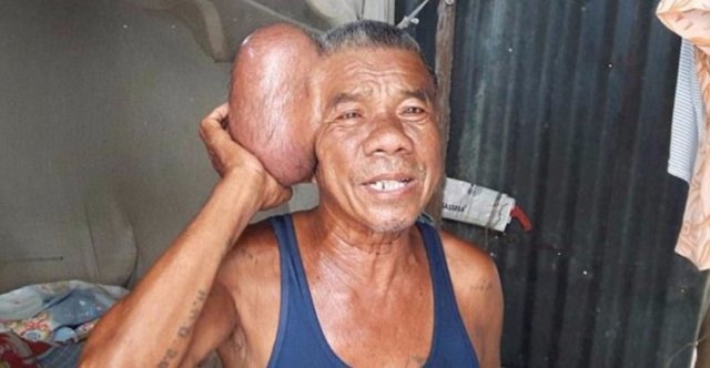 «Человек с двумя головами» - опухоль на голове у тайского пенсионера