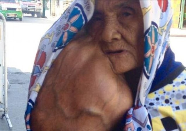 У пожилой женщины, после удаления родинки, на лице выросла огромная опухоль