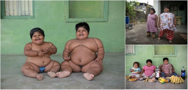 Самым толстым сестрам из Индии уменьшили желудки и они начали худеть