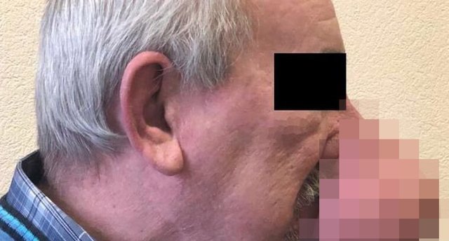 Петербургские медики отрезали мужчине полукилограммовую часть носа