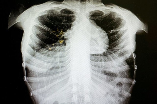 Туберкулез научились выявлять до появления симптомов