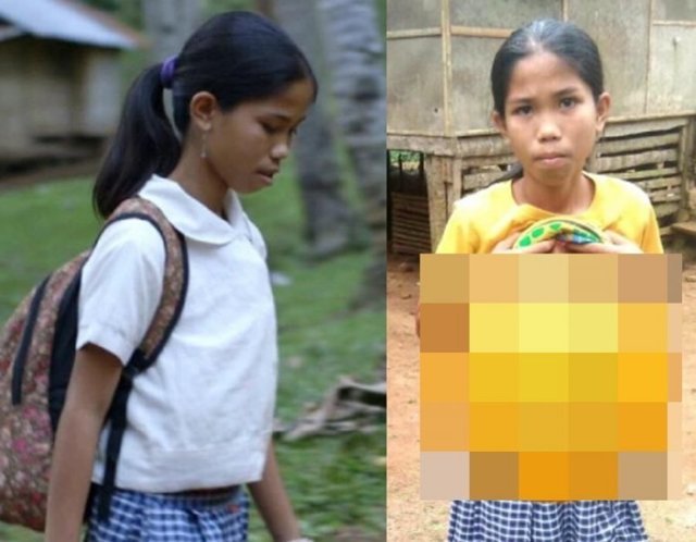 Филиппинской школьнице удалят лишние руки, растущие из живота