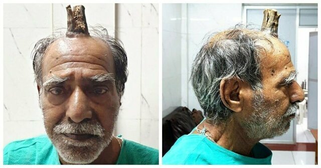 74-летнему индийцу удалили 10-сантиметровый "дьявольский рог"