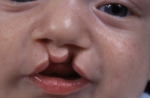 Почему дети рождаются с заячьей губой?
