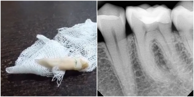 Стоматолог удалил самый большой зуб в мире