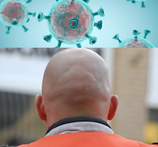 Ученые нашли тесную связь между коронавирусом и облысением мужчин