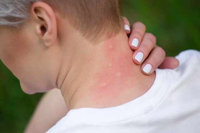 Почему возникает аллергия на укус комара?