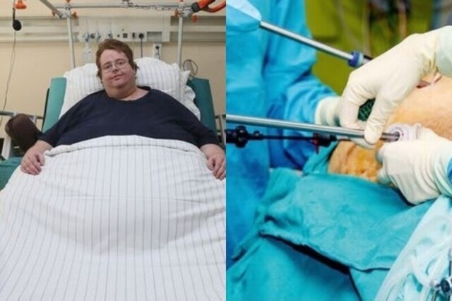 Американцу с ожирением по ошибке сделали кесарево сечение