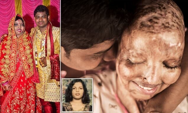 Женщина, которую 13 лет назад облили кислотой за отказ выйти замуж, нашла свою любовь