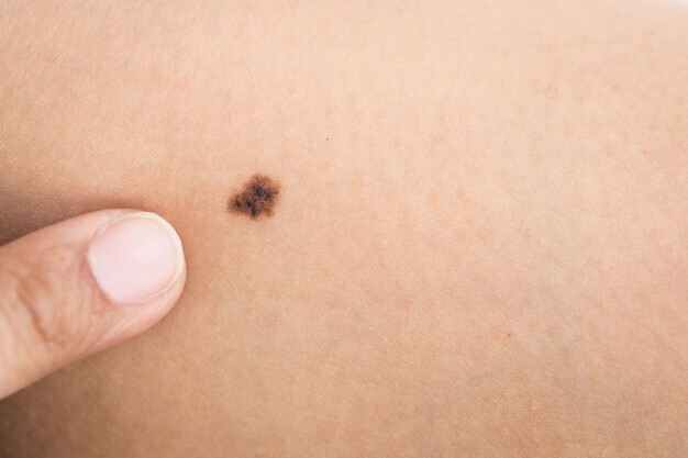 7 признаков рака кожи, на которые мало кто обращает внимания