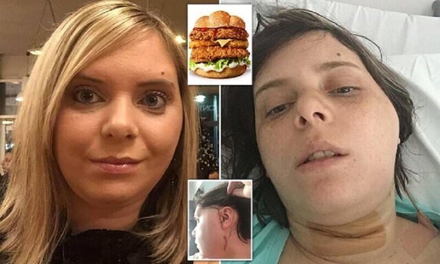 Женщина сломала челюсть бургером