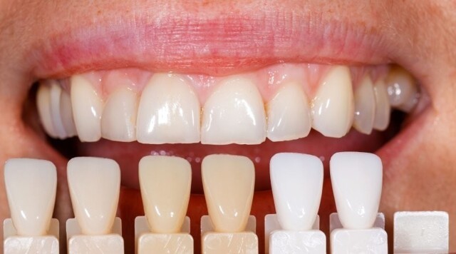  Виды отбеливания зубов – плюсы и минусы