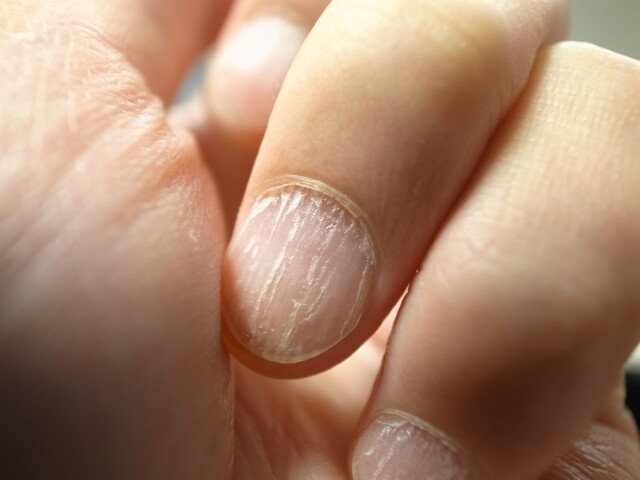 Какие изменения ногтей могут говорить о заболеваниях