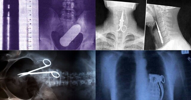 Удивительные рентгеновские снимки, способные шокировать врачей
