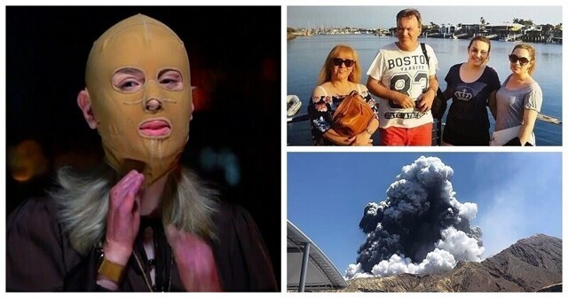 Обгоревшая во время извержения вулкана женщина показала своё лицо