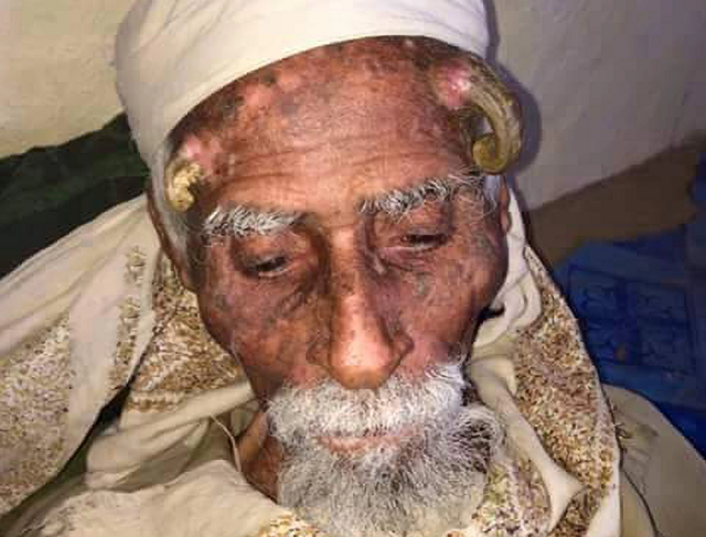 140-летний йеменец умер после удаления рогов. Говорят, они выросли после сделки с Дьяволом