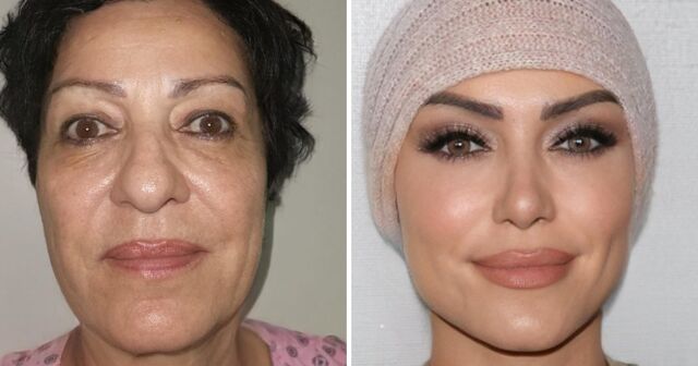 16 шокирующих работ турецких хирургов, которые буквально дарят новую внешность своим пациентам