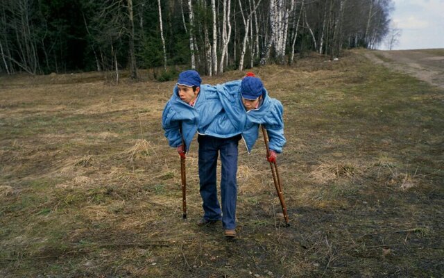 Что случилось с первыми сиамскими близнецами в СССР и как сложилась их судьба