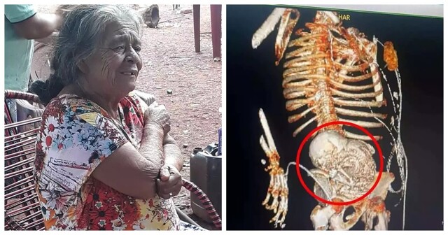 81-летняя женщина 56 лет прожила с «каменным ребёнком» в животе