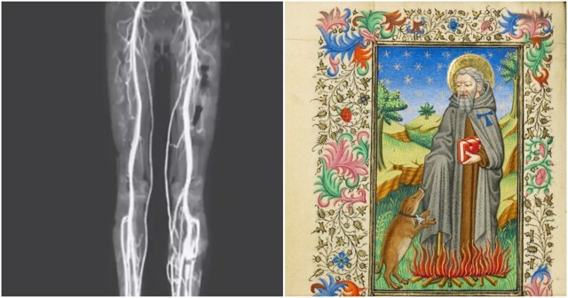 Девушка умудрилась заразиться «средневековым проклятием»