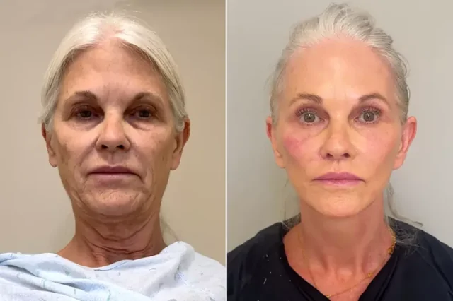 66-летняя женщина изменилась до неузнаваемости, пройдя 9 пластических операций за 6 часов