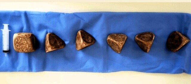 В мочевом пузыре мужчины обнаружили шесть огромных камней: вес и размер шокируют