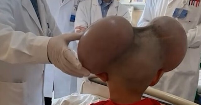 Мальчик, которого прозвали Микки Маусом, преобразился