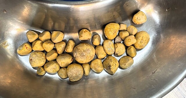 Любителю колы удалили 35 камней из мочевого пузыря