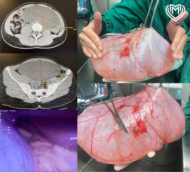 Врачи удалили гигантскую кисту в яичнике, сохранив репродуктивное здоровье девушки