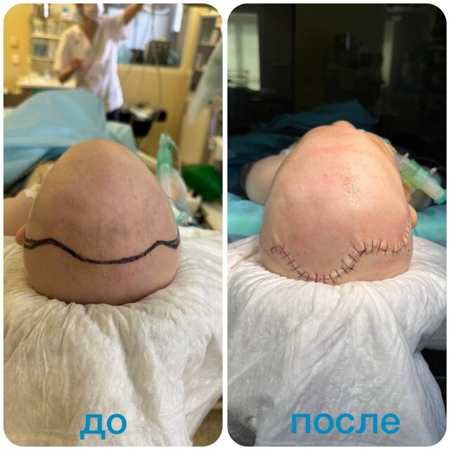 Врачи выровняли череп 8-месячному малышу с треугольной головой