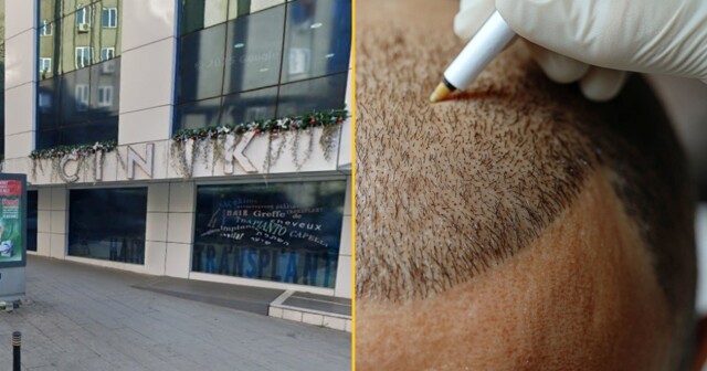 Британец умер во время пересадки волос в Турции