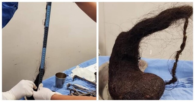 Потеряла в весе и страдала от депрессии: медики обнаружили в желудке трехлетней девочки огромный волосяной комок