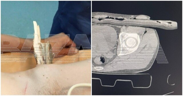 Мужчина неудачно упал на дерево в Подмосковье