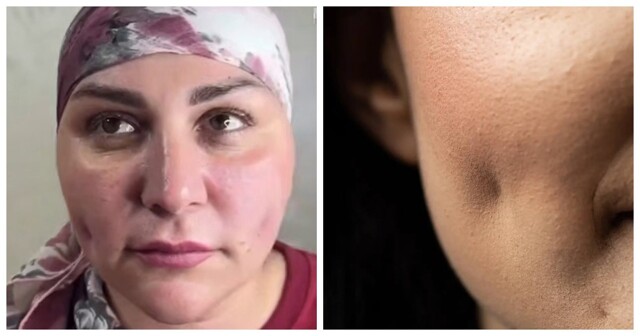 Новый модный тренд: кавказские девушки делают ямочки на щеках, чтобы выглядеть моложе и милее