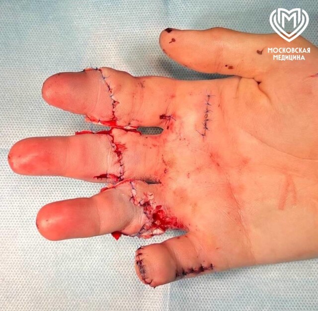 21-летнему парню пришили пальцы, которых он лишился под прессом на производстве⁠⁠