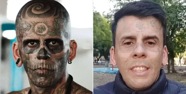 Мужчина показал свою ошеломляющую трансформацию после удаления татуировок лазером