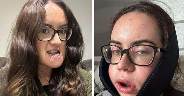 Боль того стоила: преображение девушки после операции по исправлению прикуса