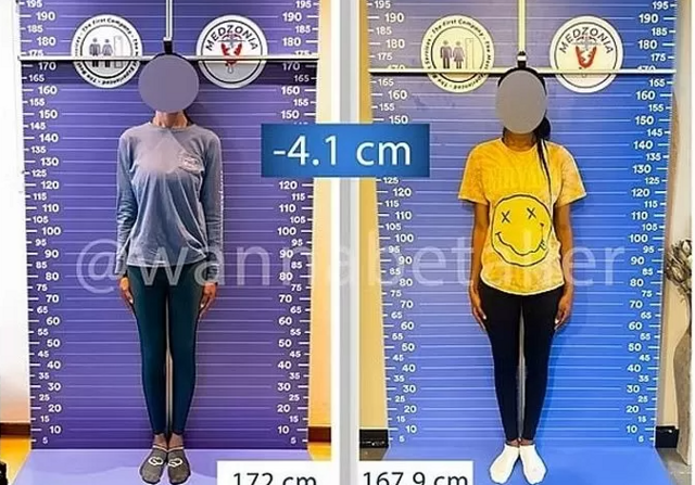 Модели больше не в моде? Зачем женщины делают операции по укорачиванию ног