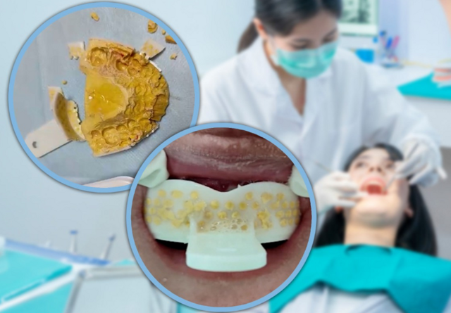 Китаец самостоятельно запломбировал себе зубы