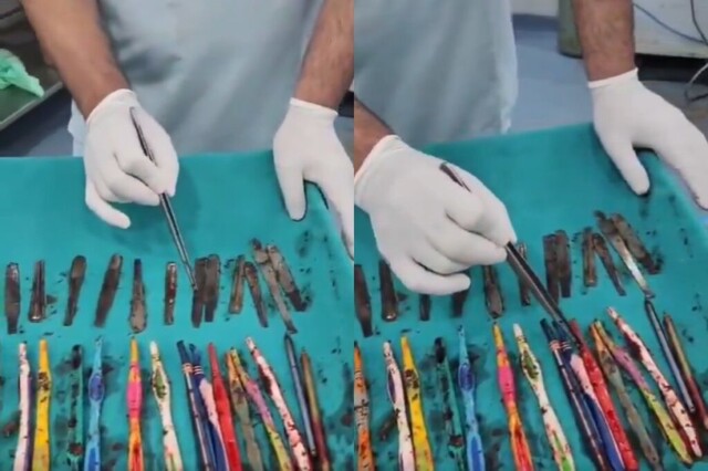 В Индии хирурги извлекли из желудка мужчины 29 ложек, 19 зубных щеток и 2 ручки