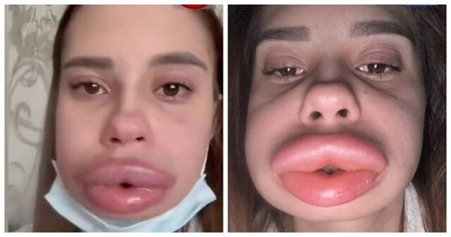 Девушка из Владикавказа хотела «сдуть» накаченные губы, а они стали только больше: начался сильнейший отек Квинке