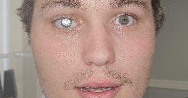 Владелец ювелирного магазина вставил в глаз бриллиант в 2 карата