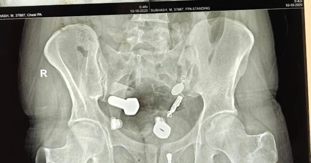 Хирурги нашли в желудке мужчины наручные часы