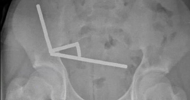 Подросток проглотил 100 магнитов и лишился части кишечника