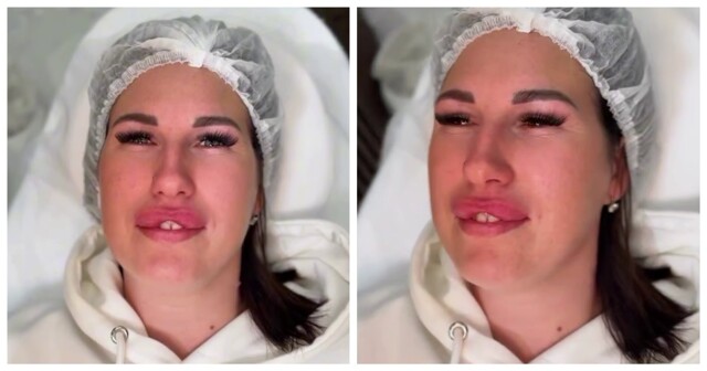 Как выглядит эффект «заячьих губок»