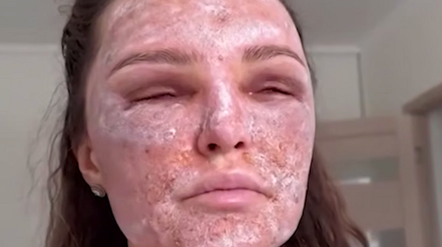 Красота с риском: как лазерная шлифовка лица калечит кожу