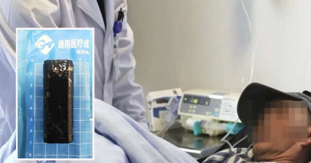 Врачи извлекли зажигалку из желудка мужчины, который в пьяном угаре проглотил её 30 лет назад