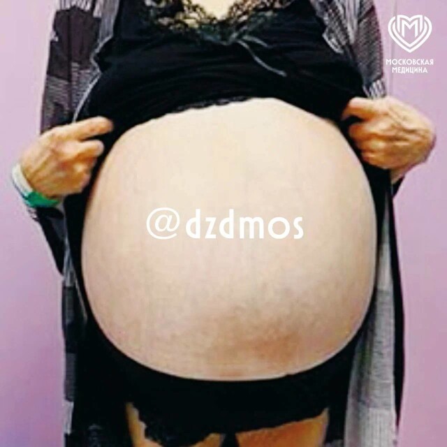 Женщина более 15 лет не ходила к врачу. Итог: гигантская опухоль весом 30 кг⁠